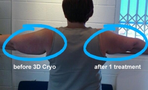 Cryolipolysis-photo-before-and-after